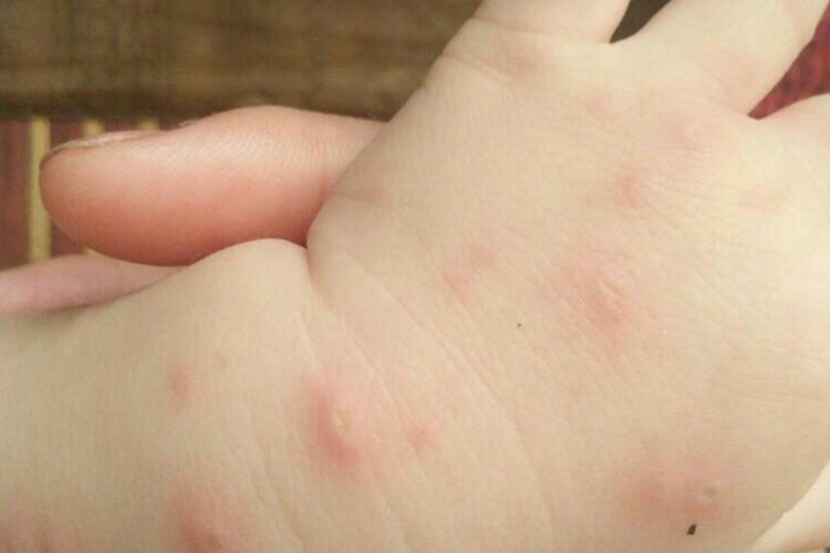 红斑丘疹类皮损图