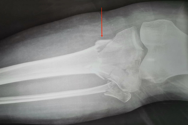 左侧胫骨平台骨折影像图