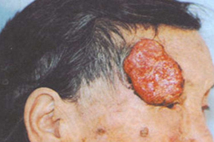 原位鳞状细胞癌肿块图 原位鳞状细胞癌肿块图