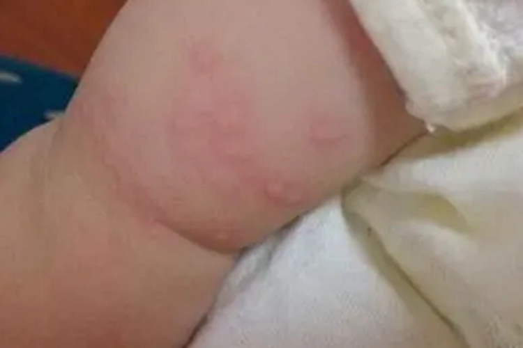 新生儿红斑胳膊上有团块图