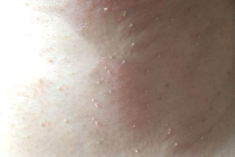 脖子处泪滴状丝状疣图