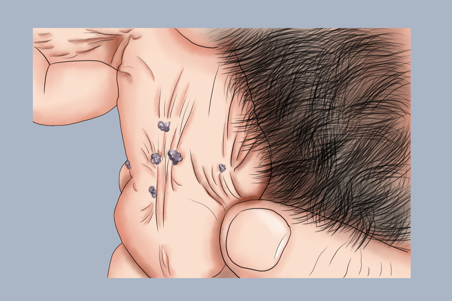 阴茎尖锐湿疣图 阴茎尖锐湿疣图