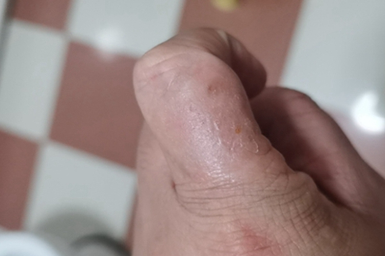 汗疱疹左手手指关节处脱屑图