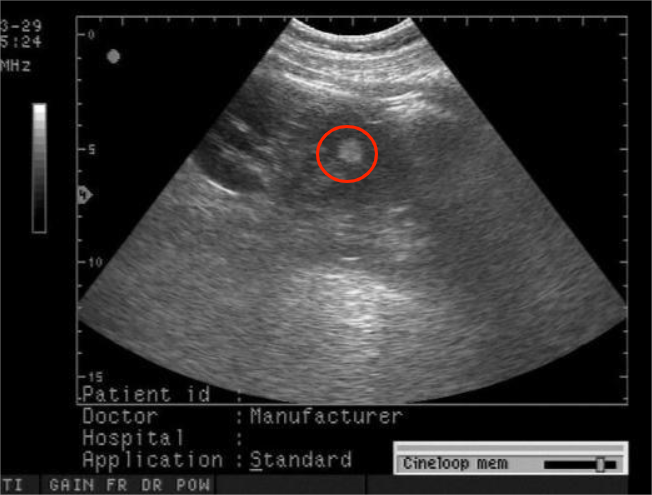 肾错构瘤超声图