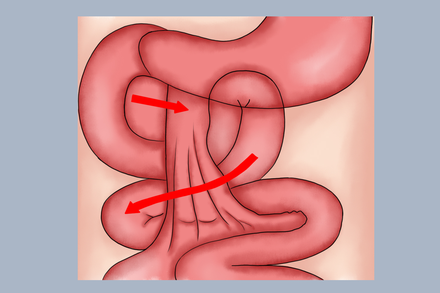 右侧十二指肠旁疝示意图