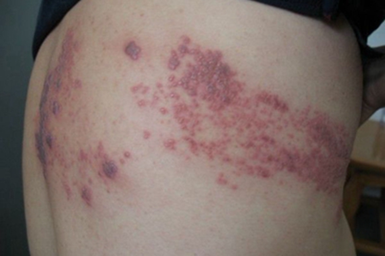 艾滋病肋部带状疱疹图 艾滋病肋部带状疱疹图