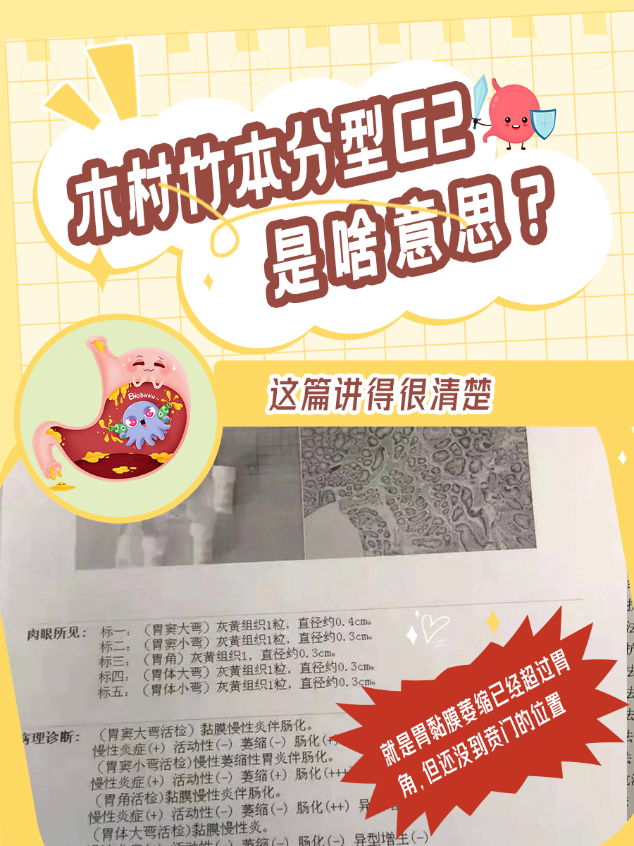 木村竹本分型C2是啥意思?这篇讲得很清楚