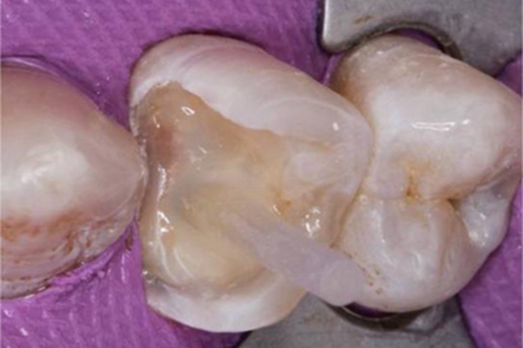 死髓牙牙齿缺损图