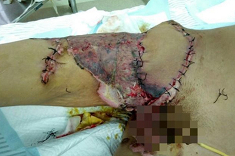 电烧伤大腿糜烂图