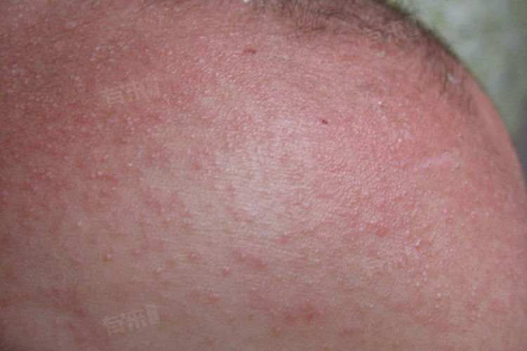 宝宝起热痱子的有效方法