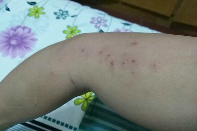 毛囊炎身上红点图