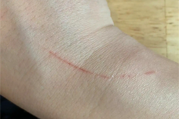 抓伤手腕症状图