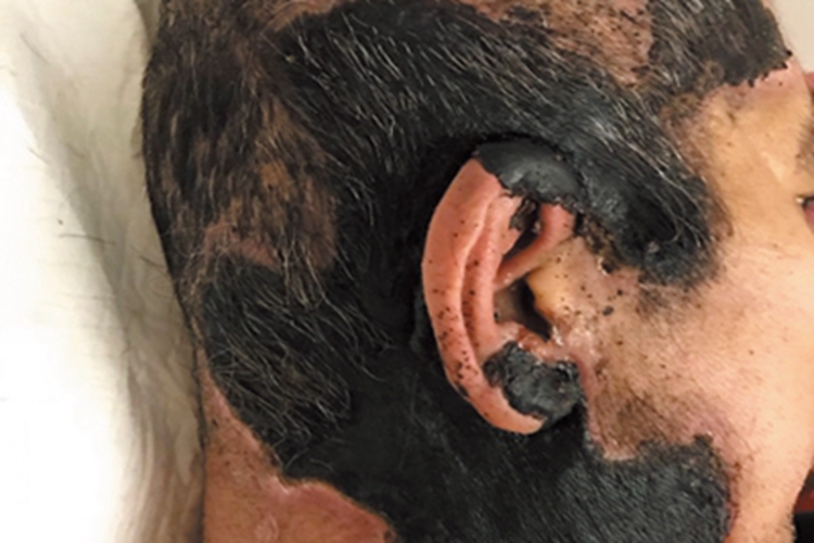 暴发性紫癜头皮一大片焦痂图