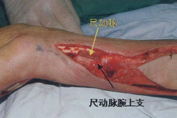 尺动脉腕上皮支皮瓣图
