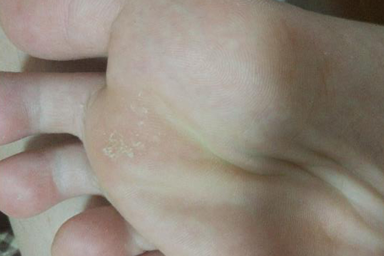 疣体脱落后皮肤恢复图