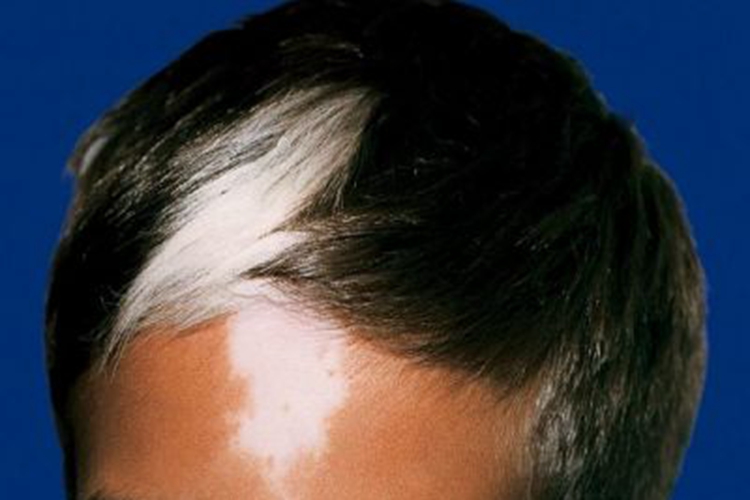 斑状白化病症状图 斑状白化病症状图