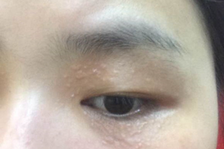 汗腺瘤左眼周围一圈小疙瘩图