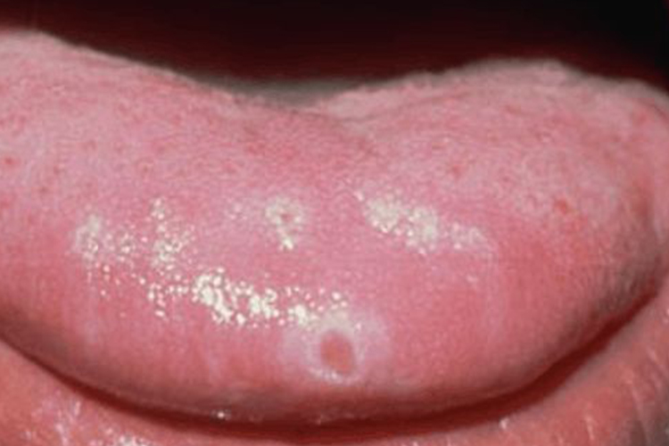 口腔溃疡快好的征兆图