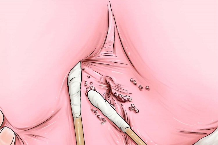 女性尖锐湿疣肛周小疙瘩手绘图