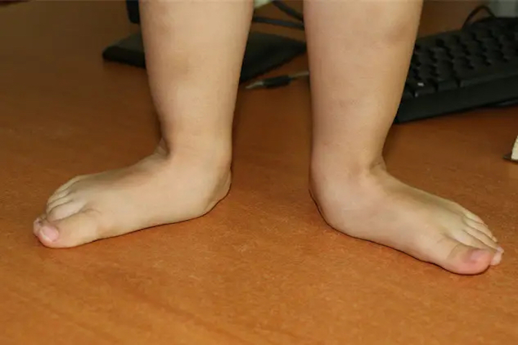 扁平足图 扁平足图