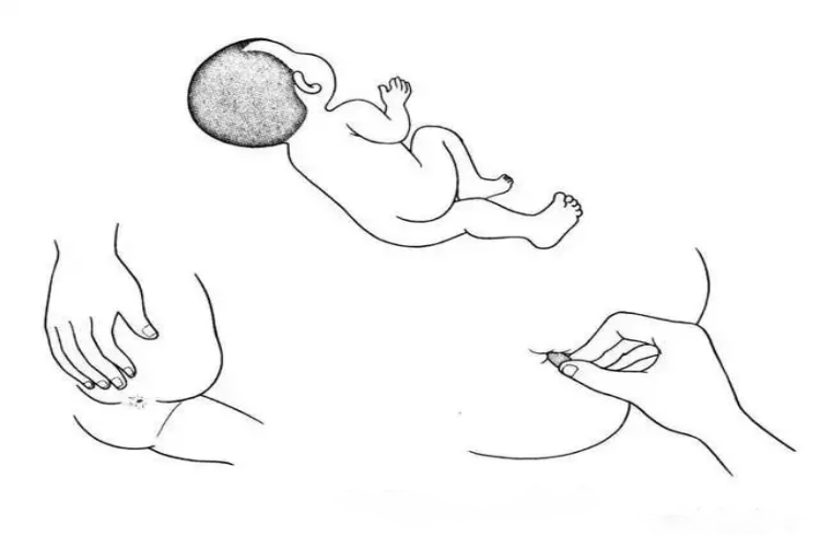 直肠栓剂插入图 直肠栓剂插入图