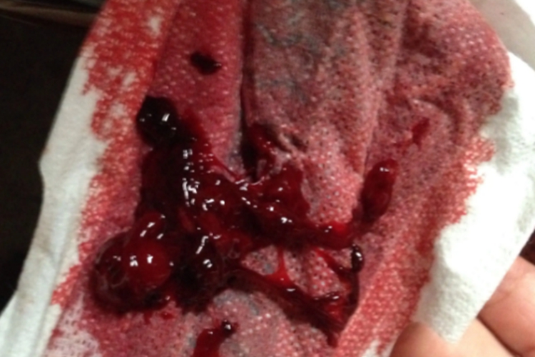 软产道裂伤排出黑血块图