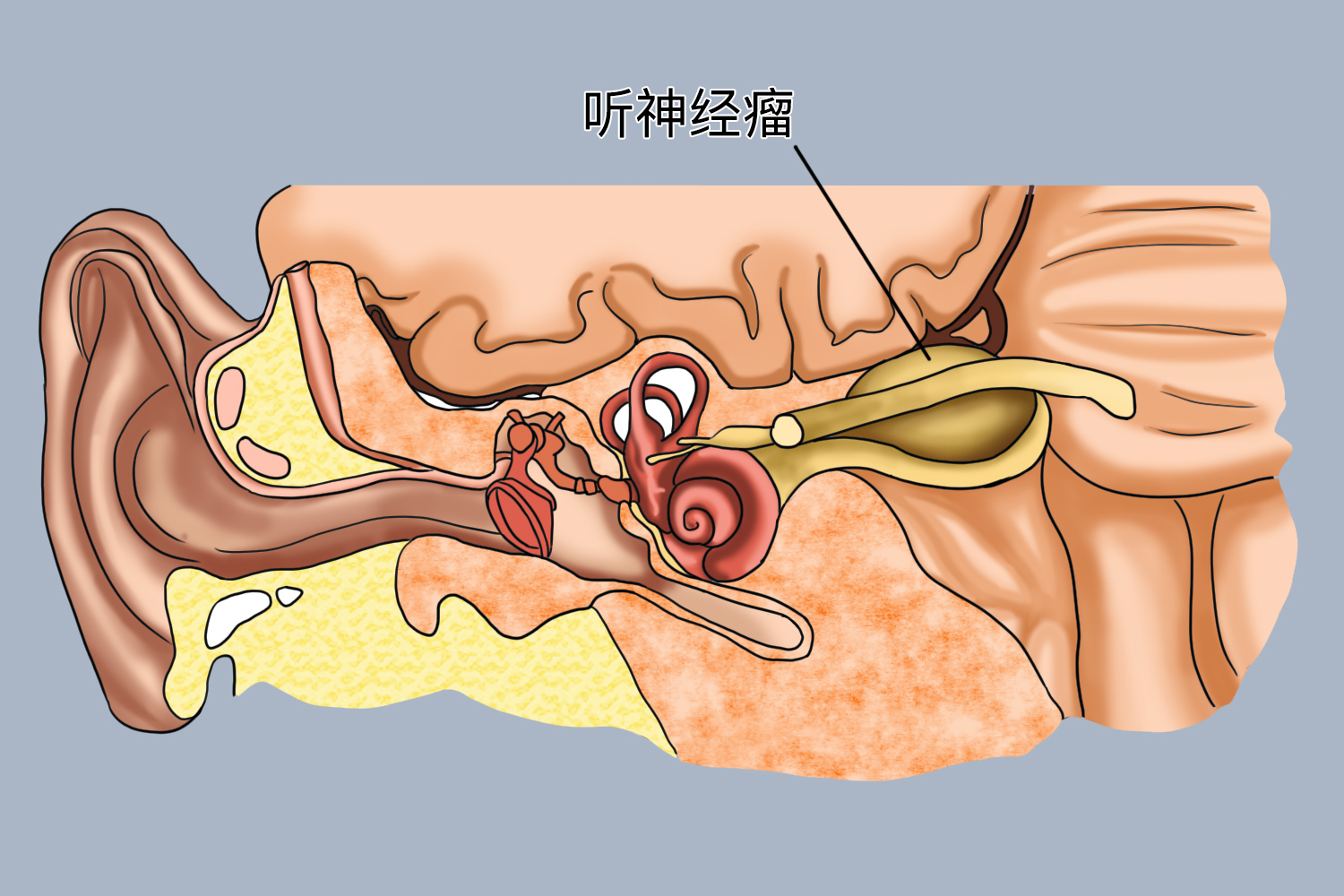 听神经瘤必须手术吗