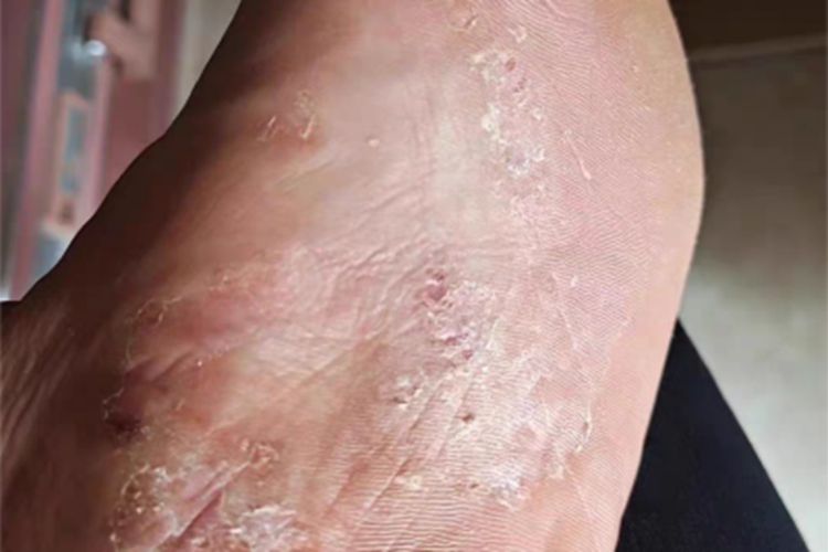 水疱型足癣脚底糜烂结痂图