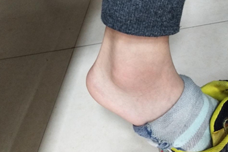 中度扭伤脚踝红肿图