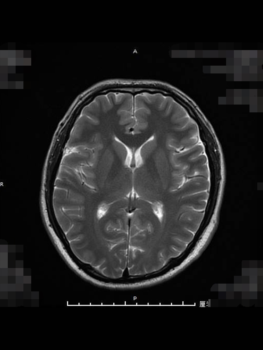 0614-王晶-高血压性脑病1-图片2.jpg