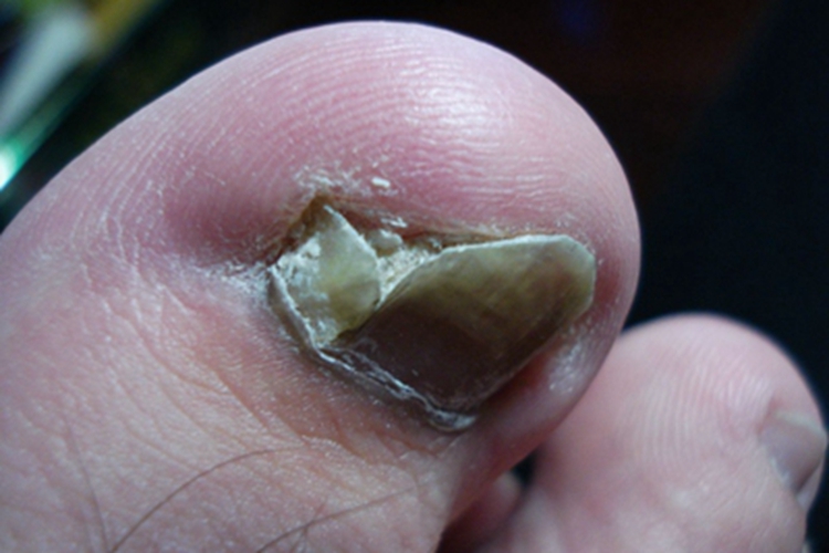 嵌甲脚趾甲畸形脚趾头红肿图 嵌甲脚趾甲畸形脚趾头红肿图