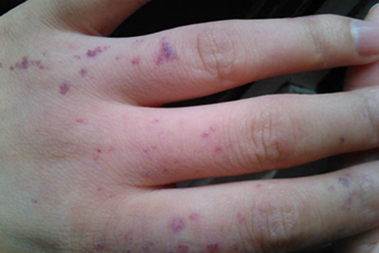 局限性血管角化瘤手指紫红丘疹图