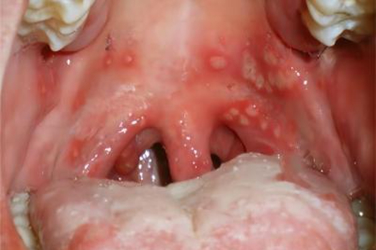 疱疹性咽峡炎咽部溃疡图