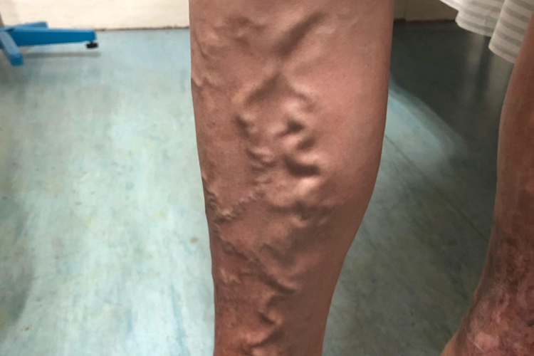 中度静脉曲张图