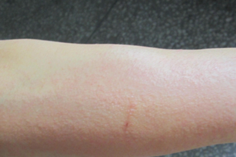 皮革皮炎胳膊一片红肿图