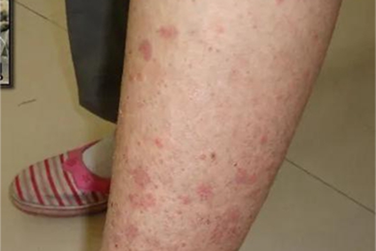 昆虫性皮炎小腿红斑图