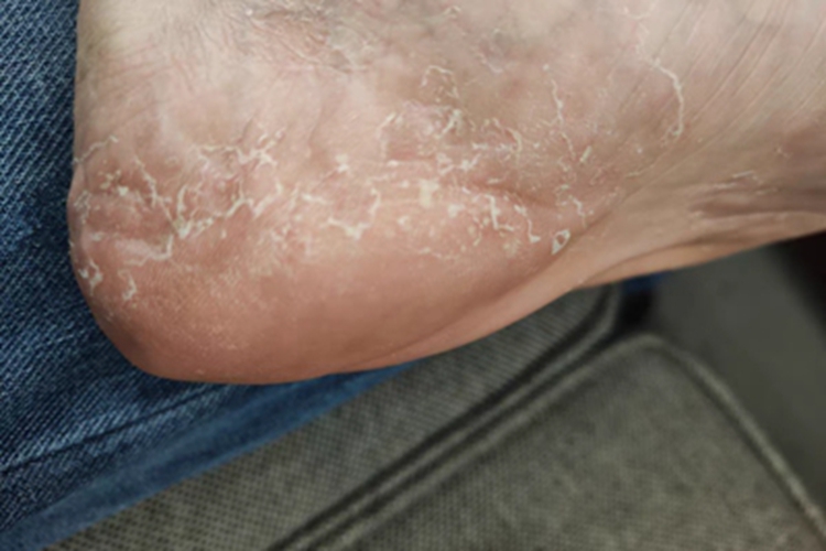 鳞屑角化型足癣脚后跟脱屑图