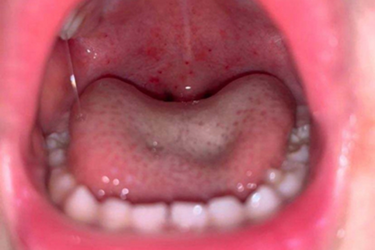 小儿疱疹性咽峡炎红点图