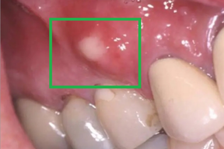 急性坏死性龈口炎牙龈疙瘩图 急性坏死性龈口炎牙龈疙瘩图