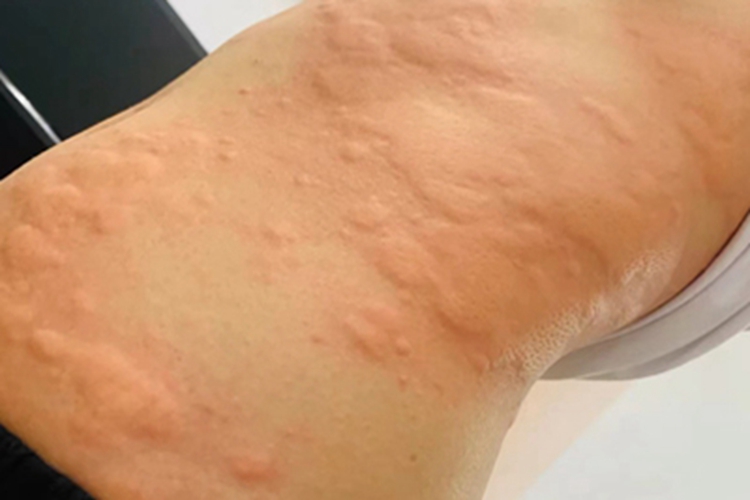 荨麻疹型药疹腰部症状图 荨麻疹型药疹腰部症状图