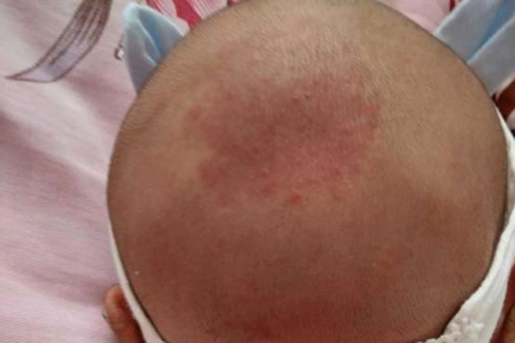 新生儿中毒性红斑头皮丘疹图 新生儿中毒性红斑头皮丘疹图