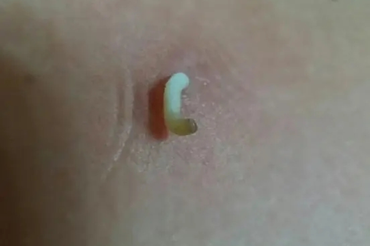 皮脂腺囊肿挤出白色絮状物图 皮脂腺囊肿挤出白色絮状物图