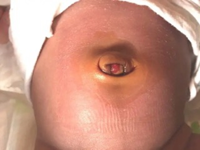 脐窝湿疹肚脐眼有一块湿润红斑图jpg