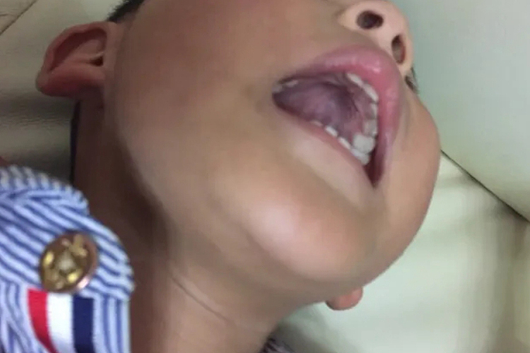 肝脑肾综合征高腭弓畸形图 肝脑肾综合征高腭弓畸形图