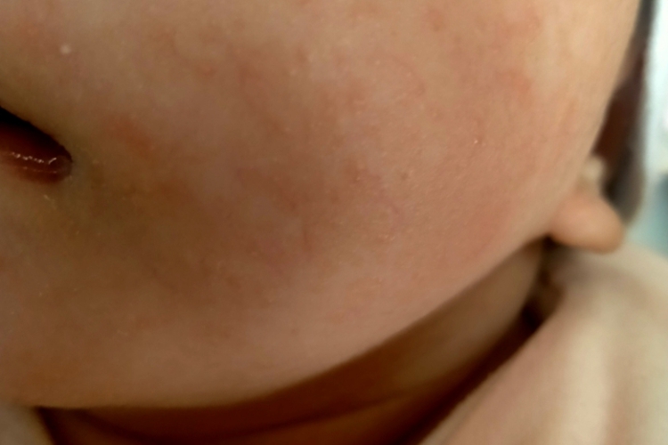 奶粉过敏丘疹图 奶粉过敏丘疹图