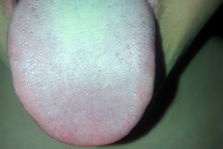 暑湿感冒舌苔图