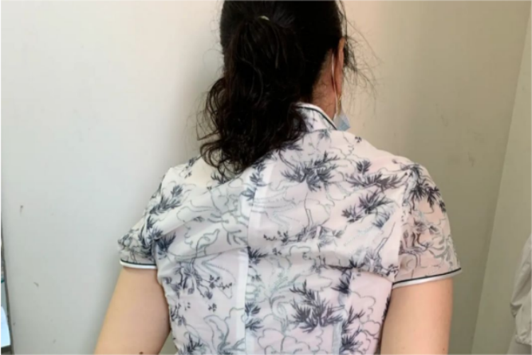 肩袖损伤内旋受限图 肩袖损伤内旋受限图