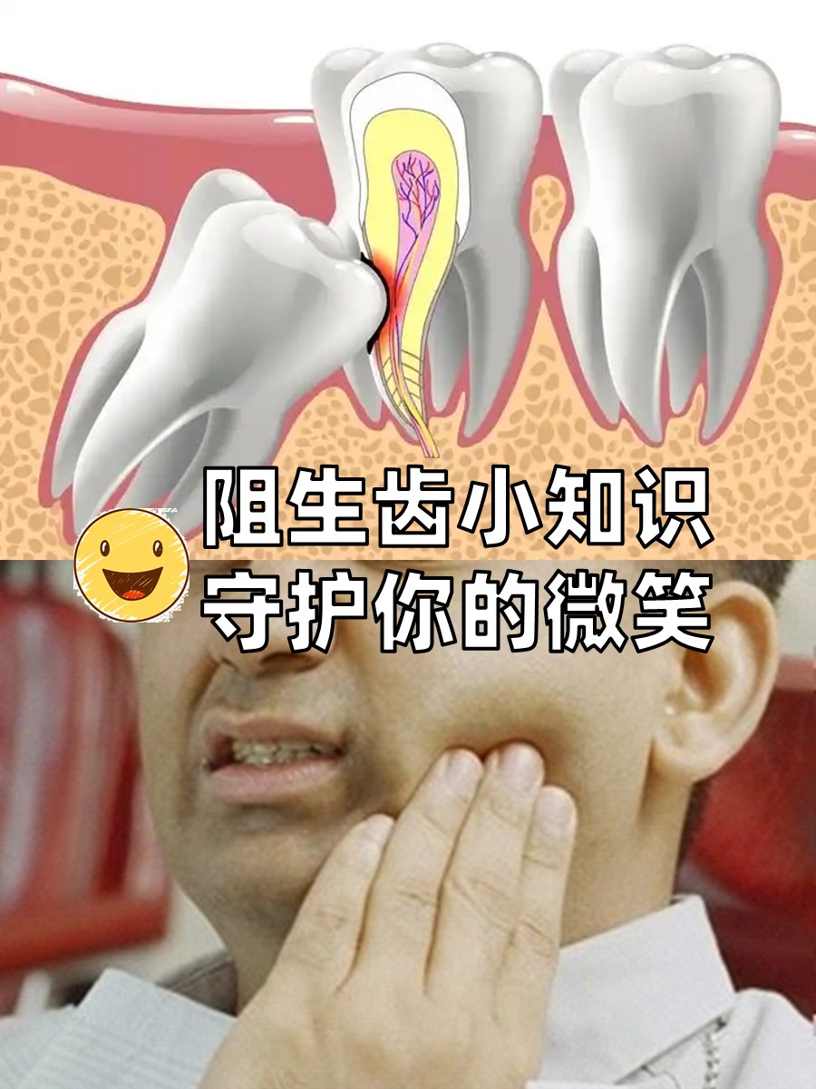 阻生齿小知识，守护你的微笑