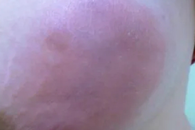 积乳囊肿红肿图