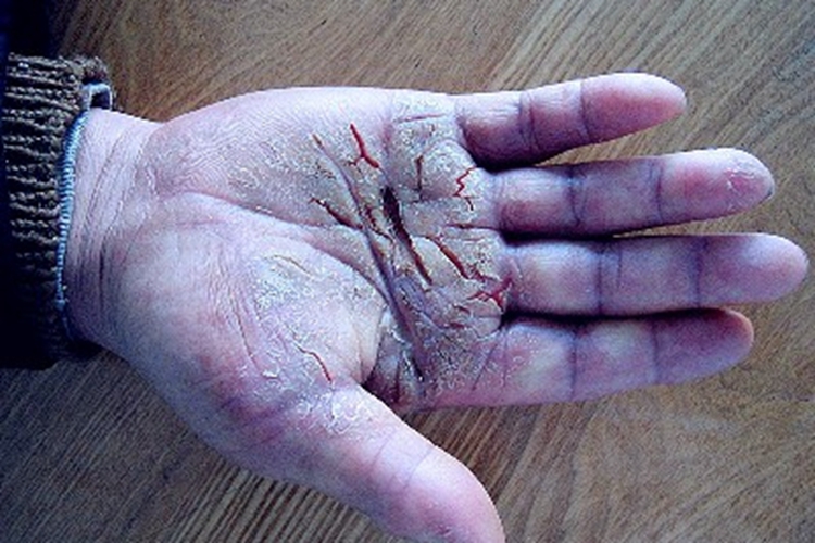 皲裂性湿疹手部皲裂图